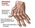 Arthritis