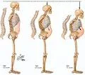 Osteoporosis